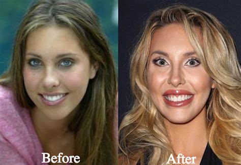 chloe before and after surgery|chloe lattanzi before surgery.